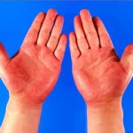 手のひらに赤い斑点が現れると病気？原因と対策について
